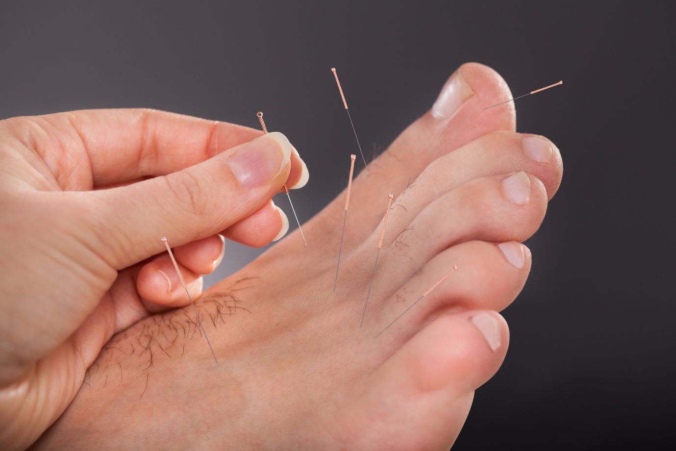 A picture of a foot undergoing a Podiatric medical acupuncture treatment. Cranstoun Footcare in East Linton, specialise in Podiatric Acupuncture
